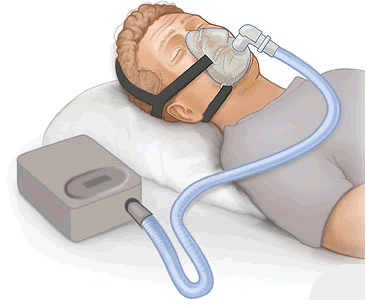 سعر جهاز BiPAP في مصر: لماذا يختلف عن CPAP وما الذي يجب مراجعته قبل الشراء؟